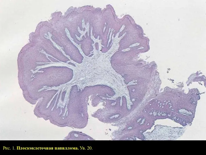 Рис. 1. Плоскоклеточная папиллома. Ув. 20.