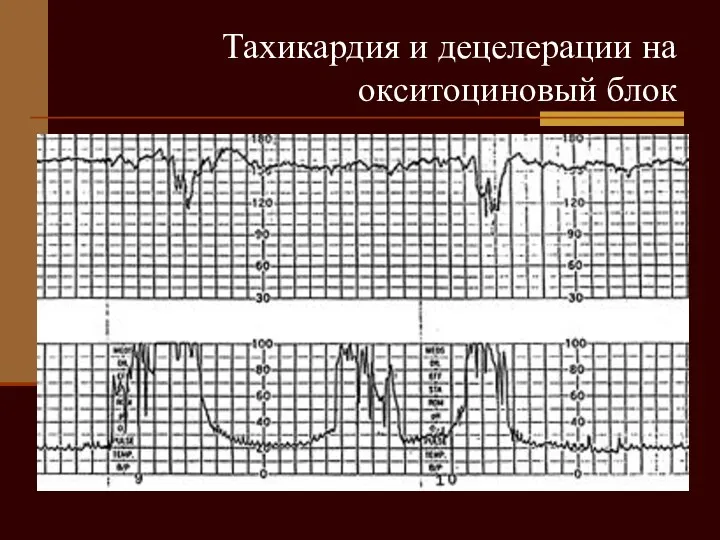 Тахикардия и децелерации на окситоциновый блок