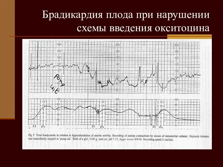 Брадикардия плода при нарушении схемы введения окситоцина