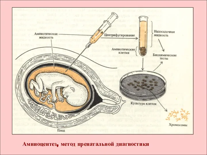 Амниоцентез, метод пренатальной диагностики