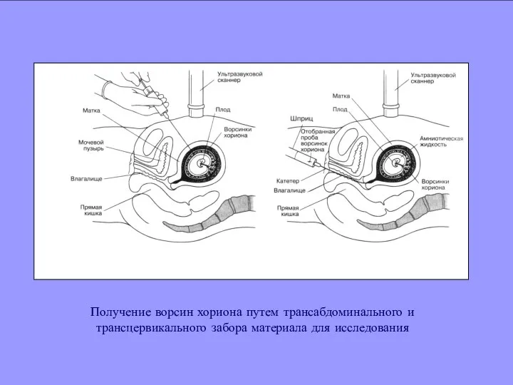 Получение ворсин хориона путем трансабдоминального и трансцервикального забора материала для исследования