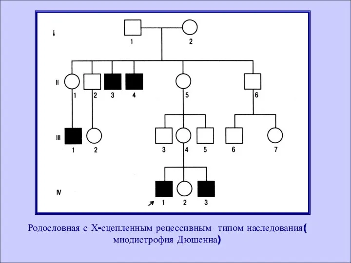 Родословная с Х-сцепленным рецессивным типом наследования( миодистрофия Дюшенна)