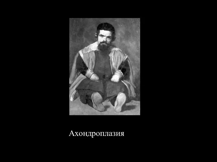 Ахондроплазия