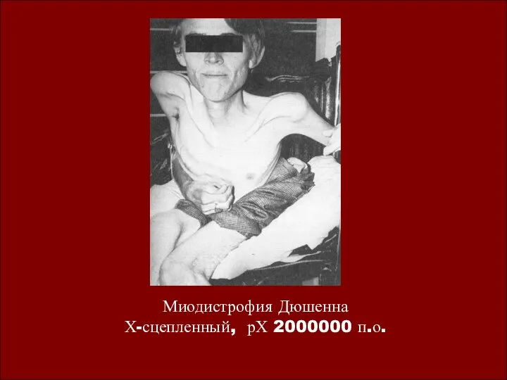 Миодистрофия Дюшенна Х-сцепленный, рХ 2000000 п.о.