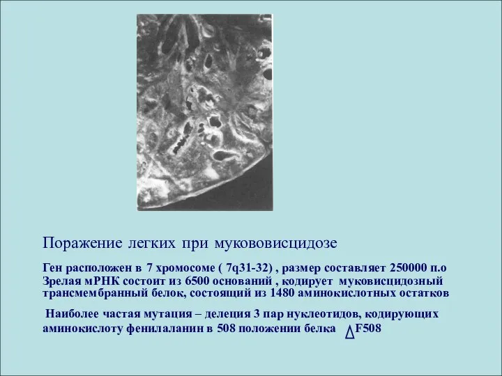 Поражение легких при мукововисцидозе Ген расположен в 7 хромосоме ( 7q31-32)