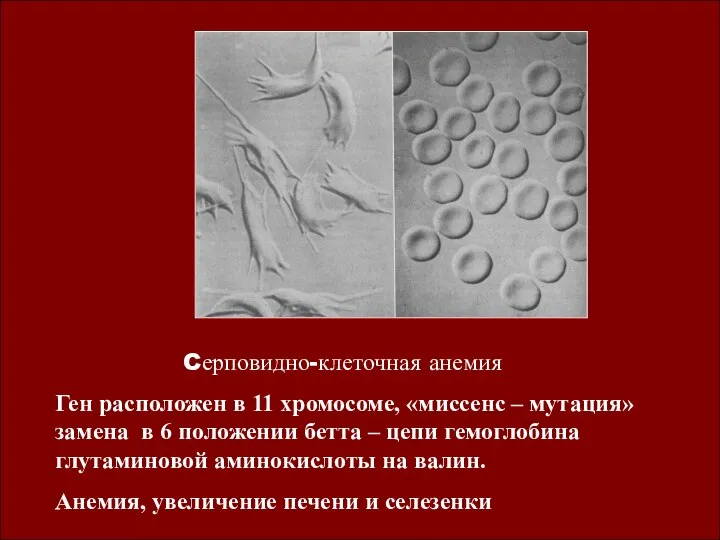 Cерповидно-клеточная анемия Ген расположен в 11 хромосоме, «миссенс – мутация» замена