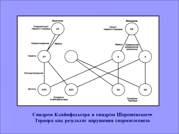 Синдром Клайнфельтера и синдром Шерешевского- Тернера как результат нарушения сперматогенеза