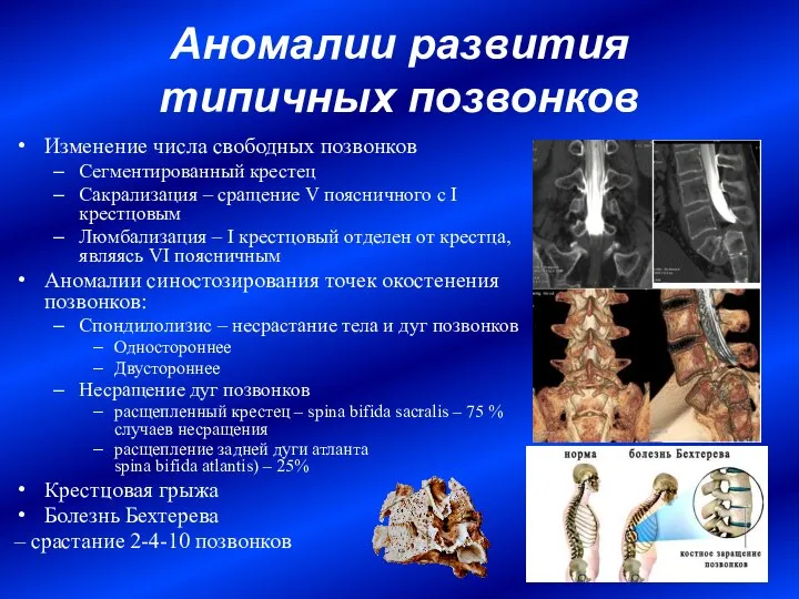 Аномалии развития типичных позвонков Изменение числа свободных позвонков Сегментированный крестец Сакрализация