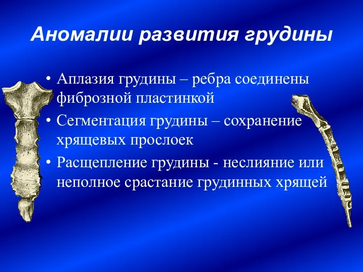 Аномалии развития грудины Аплазия грудины – ребра соединены фиброзной пластинкой Сегментация