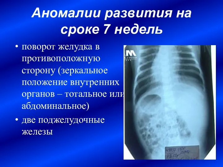 Аномалии развития на сроке 7 недель поворот желудка в противоположную сторону