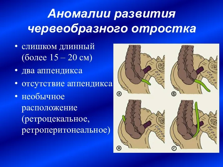 Аномалии развития червеобразного отростка слишком длинный (более 15 – 20 см)