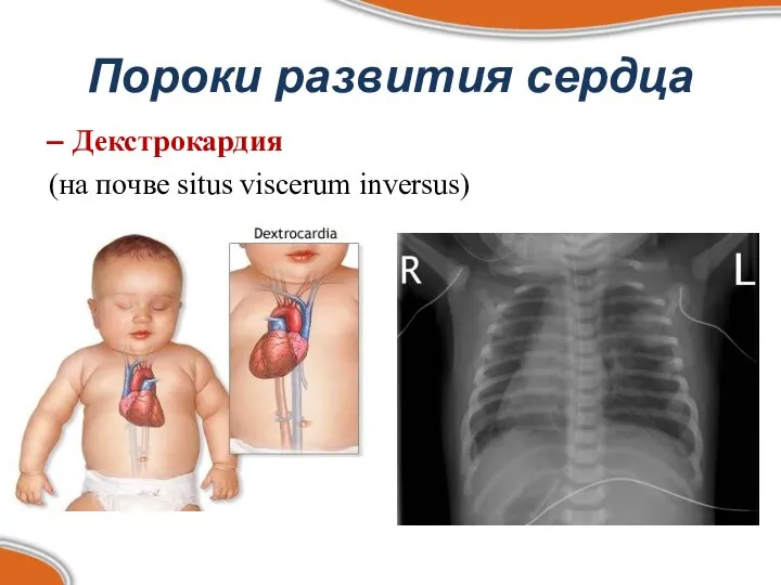 Пороки развития сердца Декстрокардия (на почве situs viscerum inversus)