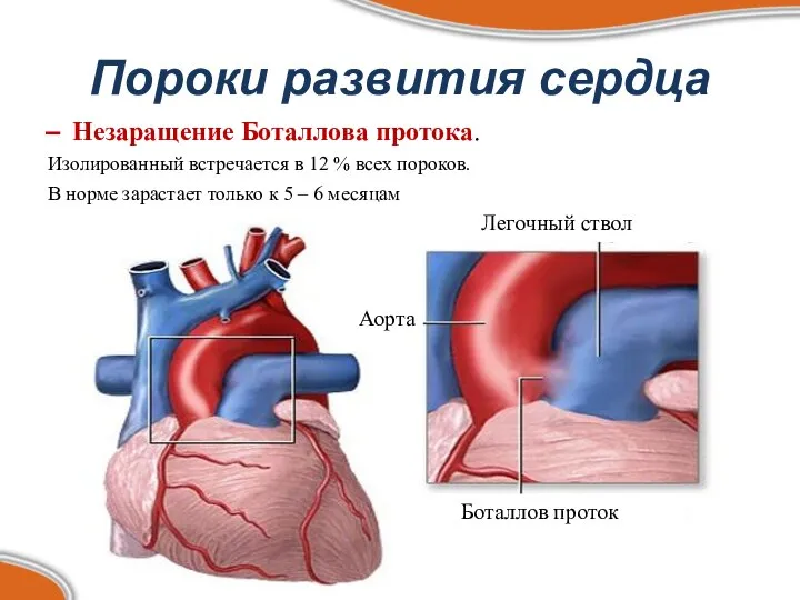 Пороки развития сердца Незаращение Боталлова протока. Изолированный встречается в 12 %