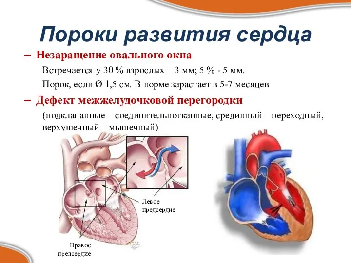Пороки развития сердца Незаращение овального окна Встречается у 30 % взрослых