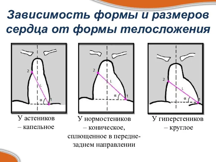 Зависимость формы и размеров сердца от формы телосложения У гиперстеников –