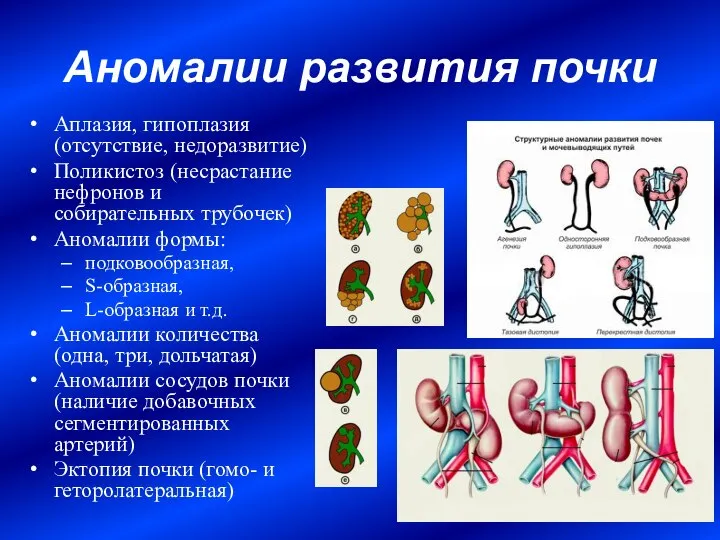 Аномалии развития почки Аплазия, гипоплазия (отсутствие, недоразвитие) Поликистоз (несрастание нефронов и