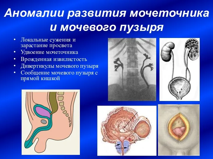 Аномалии развития мочеточника и мочевого пузыря Локальные сужения и зарастание просвета