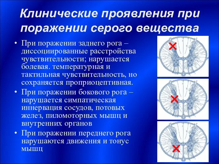 Клинические проявления при поражении серого вещества При поражении заднего рога –