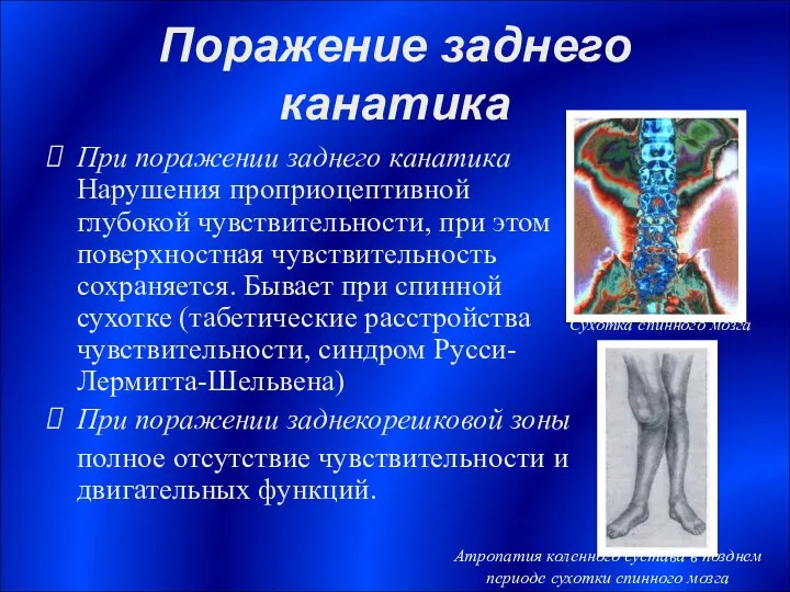 Поражение заднего канатика При поражении заднего канатика Нарушения проприоцептивной глубокой чувствительности,