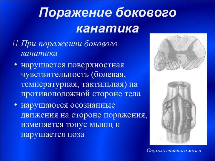 Поражение бокового канатика При поражении бокового канатика нарушается поверхностная чувствительность (болевая,