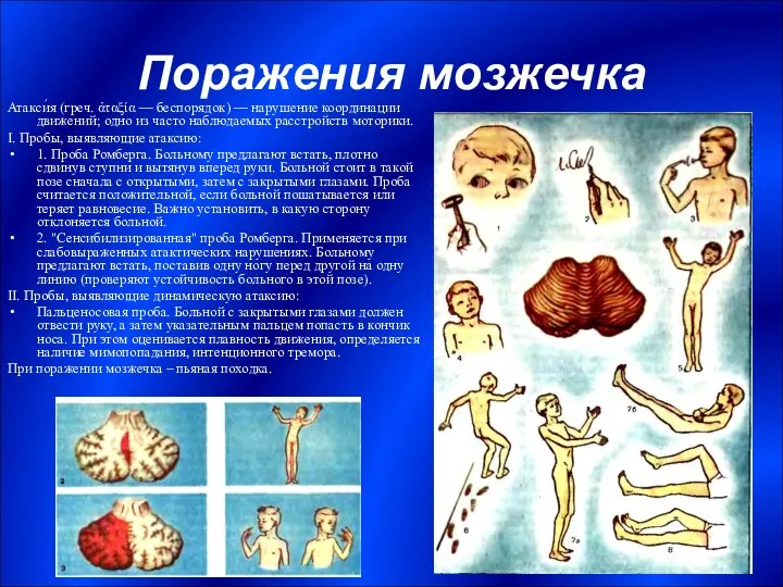 Поражения мозжечка Атакси́я (греч. ἀταξία — беспорядок) — нарушение координации движений;