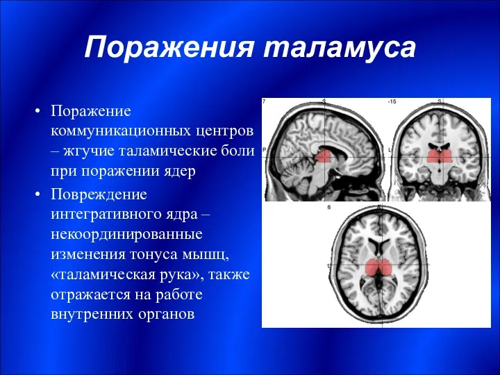 Поражения таламуса Поражение коммуникационных центров – жгучие таламические боли при поражении