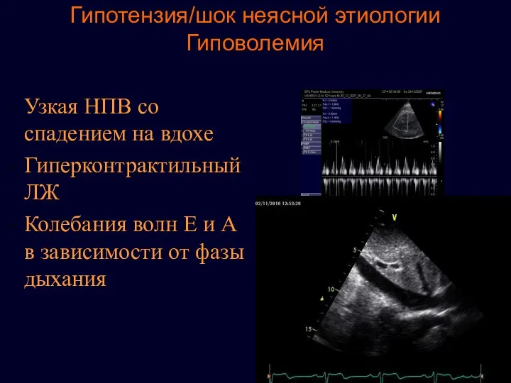 Гипотензия/шок неясной этиологии Гиповолемия Узкая НПВ со спадeнием на вдохе Гиперконтрактильный