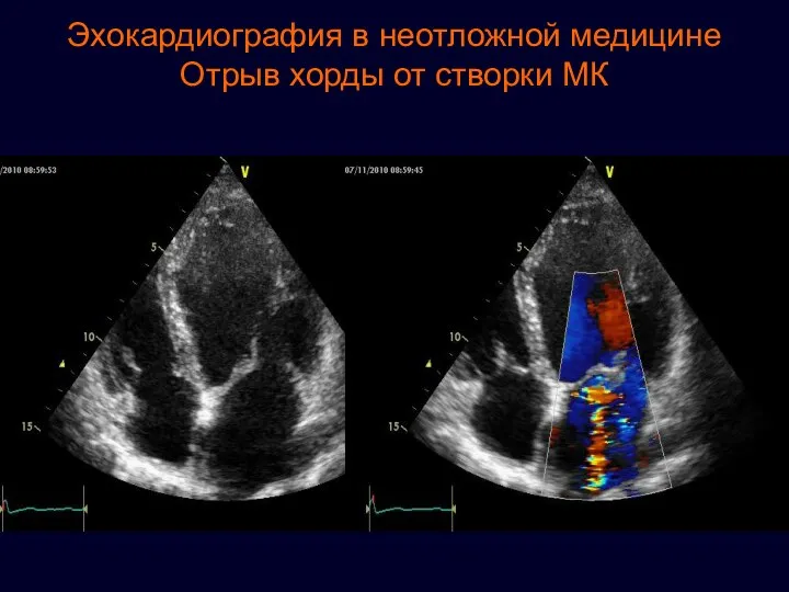 Эхокардиография в неотложной медицине Отрыв хорды от створки МК