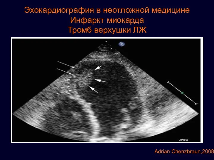 Эхокардиография в неотложной медицине Инфаркт миокарда Тромб верхушки ЛЖ Adrian Chenzbraun,2008