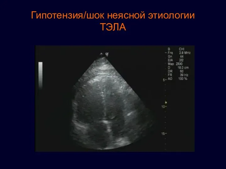 Гипотензия/шок неясной этиологии ТЭЛА