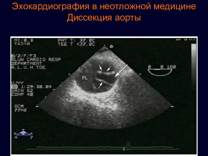 Эхокардиография в неотложной медицине Диссекция аорты