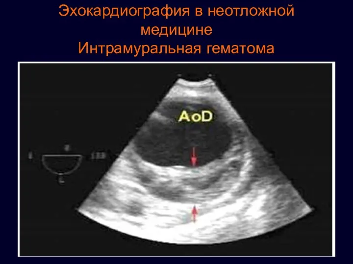 Эхокардиография в неотложной медицине Интрамуральная гематома