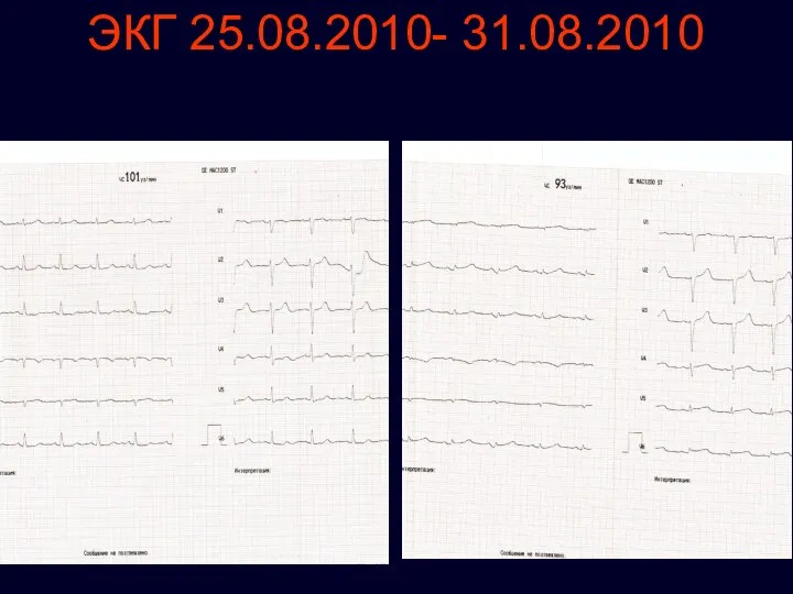 ЭКГ 25.08.2010- 31.08.2010