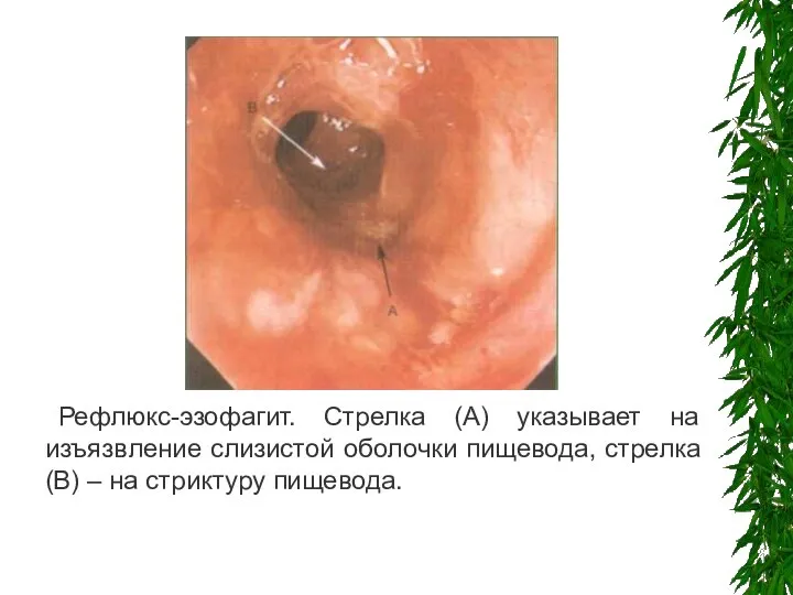 Рефлюкс-эзофагит. Стрелка (А) указывает на изъязвление слизистой оболочки пищевода, стрелка (В) – на стриктуру пищевода.