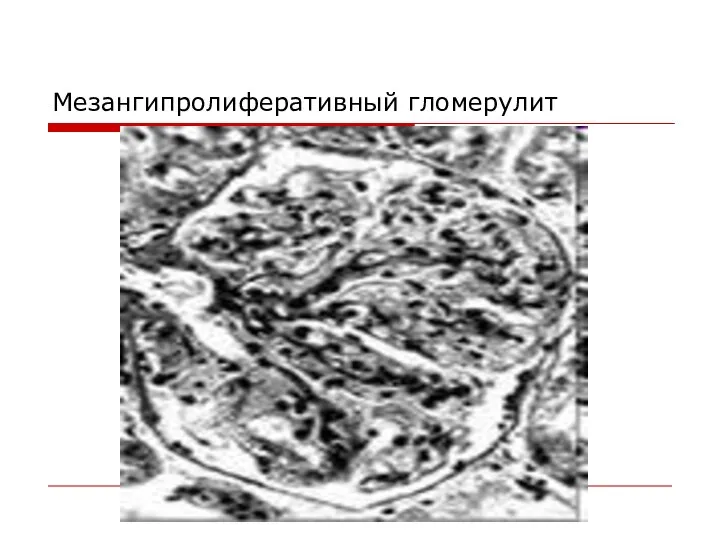 Мезангипролиферативный гломерулит