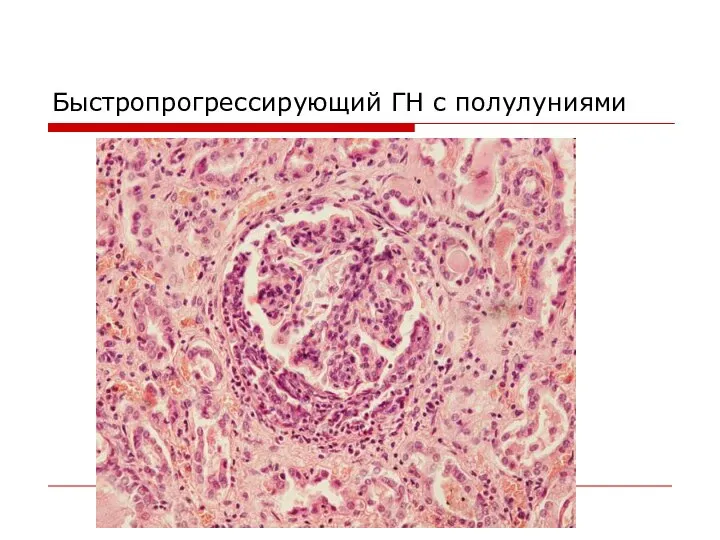 Быстропрогрессирующий ГН с полулуниями