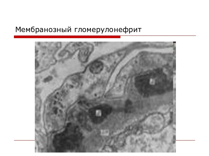 Мембранозный гломерулонефрит