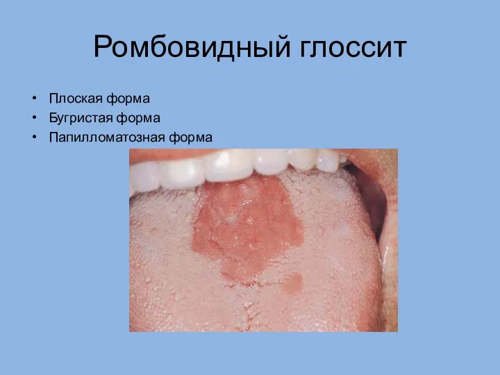 Ромбовидный глоссит Плоская форма Бугристая форма Папилломатозная форма