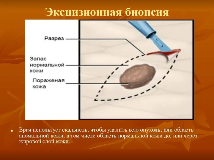 Эксцизионная биопсия Врач использует скальпель, чтобы удалить всю опухоль, или область