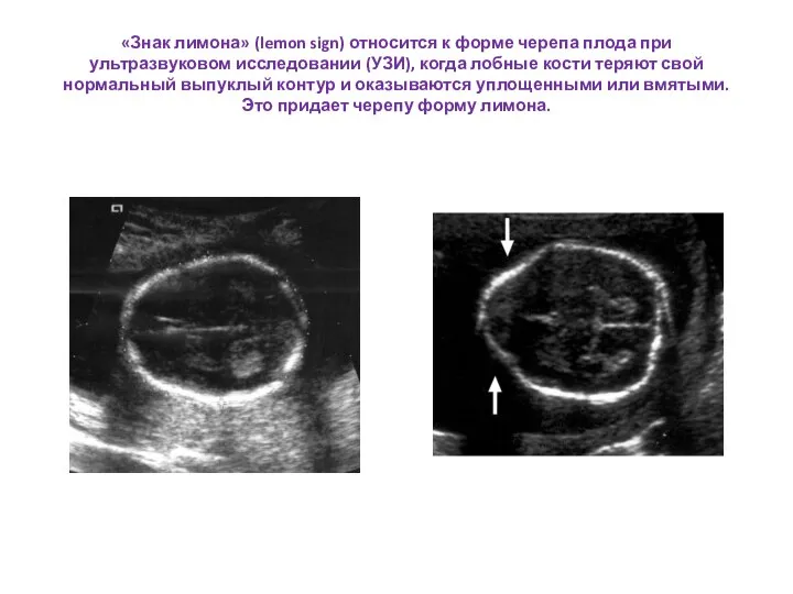 «Знак лимона» (lemon sign) относится к форме черепа плода при ультразвуковом