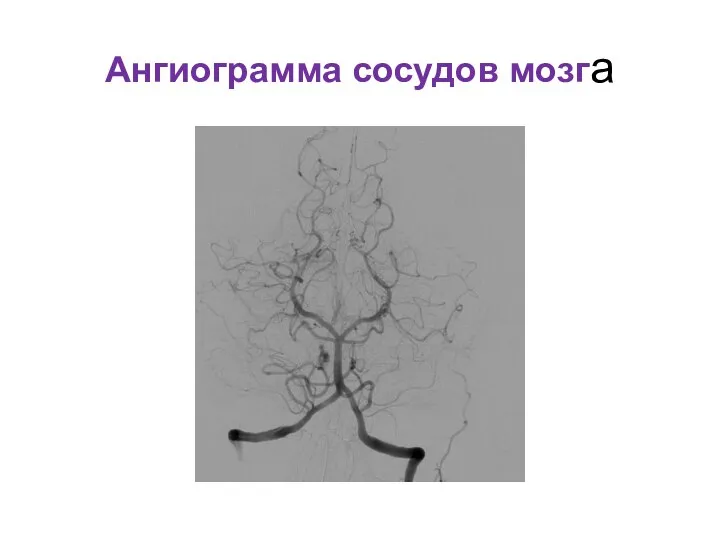 Ангиограмма сосудов мозга