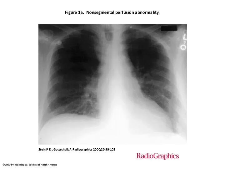 Figure 1a. Nonsegmental perfusion abnormality. Stein P D , Gottschalk A