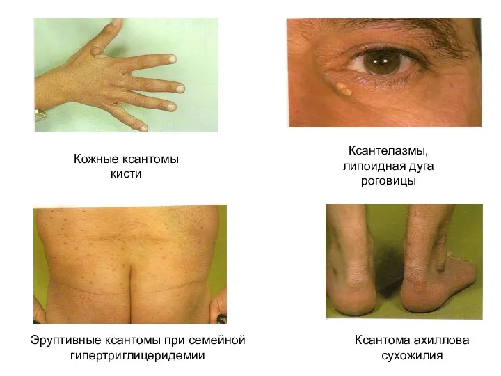 Кожные ксантомы кисти Ксантелазмы, липоидная дуга роговицы Эруптивные ксантомы при семейной гипертриглицеридемии Ксантома ахиллова сухожилия