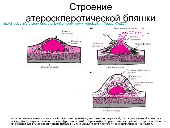 Строение атеросклеротической бляшки а - эластичная «желтая» бляшка с большим липидным