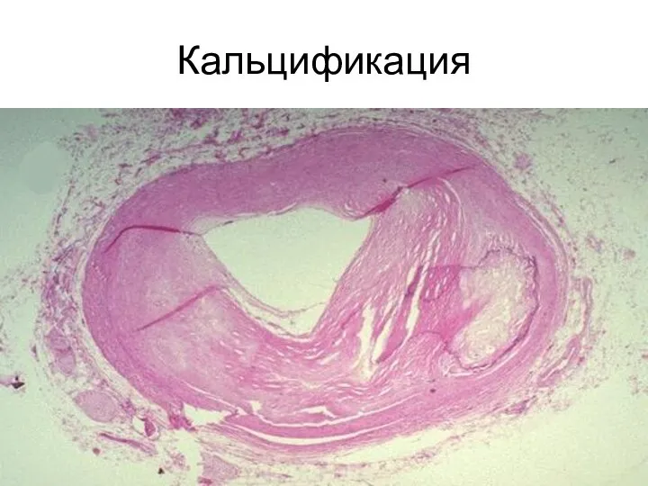 Кальцификация