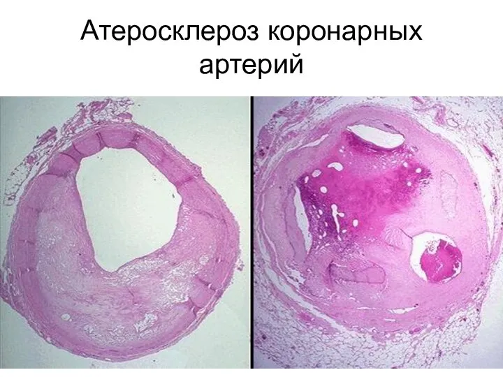 Атеросклероз коронарных артерий