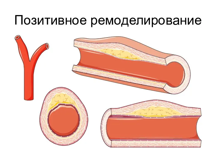 Позитивное ремоделирование