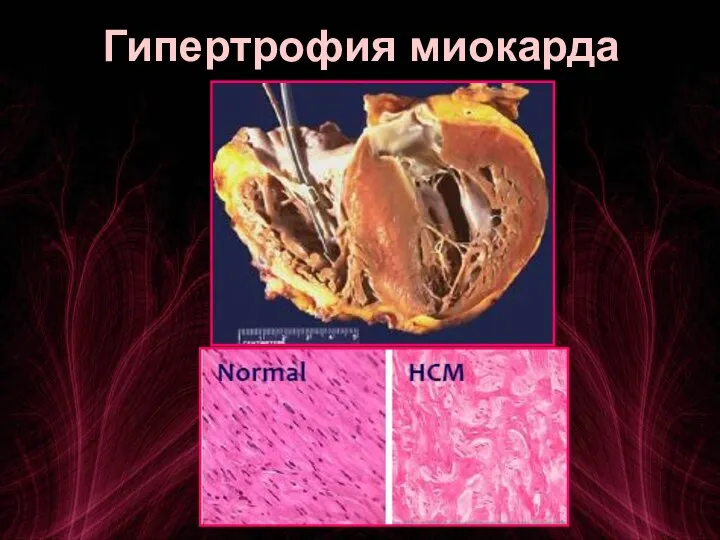 Гипертрофия миокарда