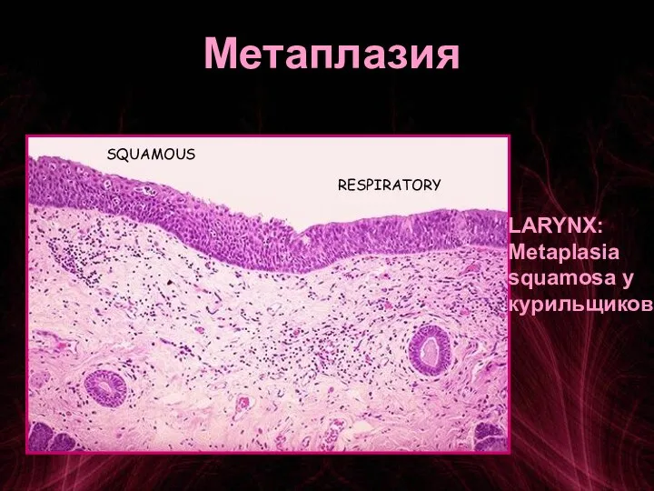 Метаплазия SQUAMOUS RESPIRATORY LARYNX: Metaplasia squamosa у курильщиков