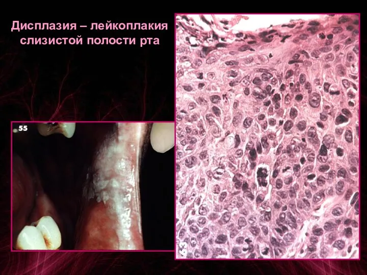 Дисплазия – лейкоплакия слизистой полости рта